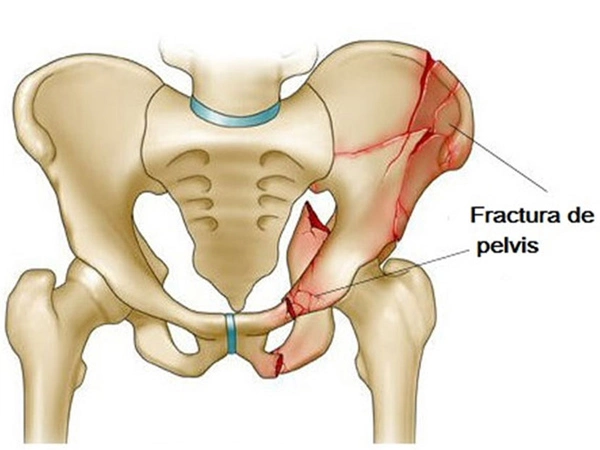 Pelvic and Complex Trauma