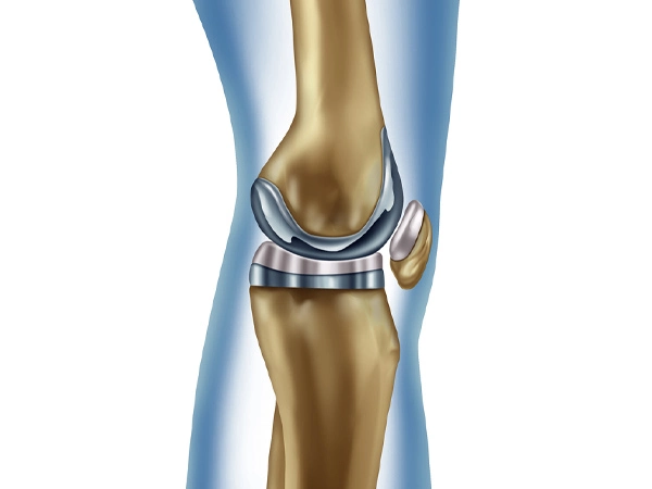 Knee Replacement